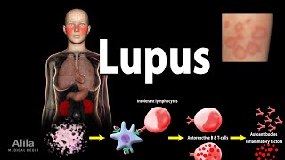 Lupus: Symptoms, Risk factors, Pathophysiology, Diagnosis and Treatments.