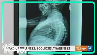 Scoliosis awareness: What you should know | Wake-Up Wellness