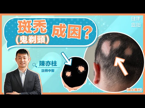 中醫拆解斑禿(鬼剃頭)成因及治療方法 | #健康查證