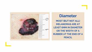 ABCDE and F Guide to detect skin cancer and melanoma