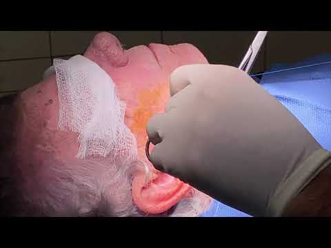 Full Excision and Repair of a Facial Skin Cancer in the Operating Room