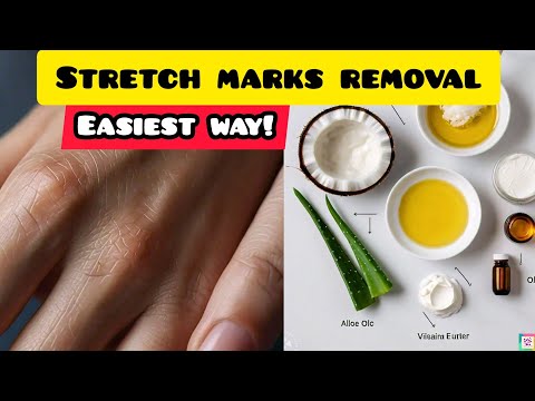 Stretch Marks Removal| How to remove Stretch Marks| stretch marks | Pregnancy Stretch Marks