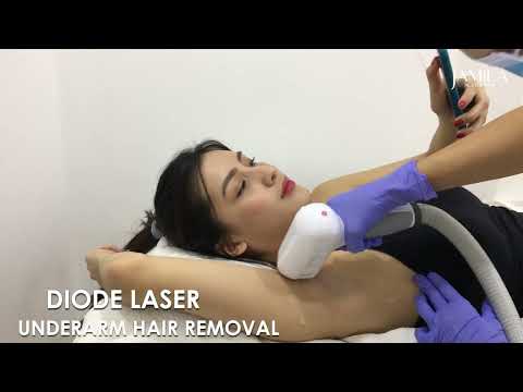 DIODE LASER HAIR REMOVAL UNDERARM