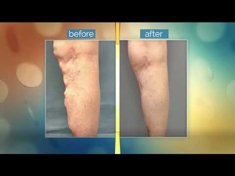 KATU AM Northwest Interviews Dr. Jason Gilster on Varicose Veins