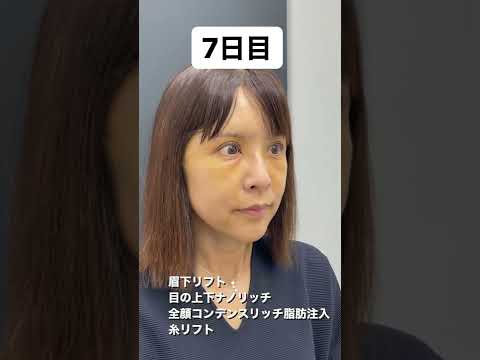 全顔フル整形のダウンタイム※腫れが引いた後の動画は概要欄からどうぞ※