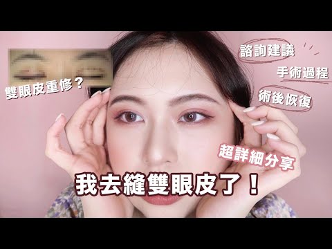 我去縫雙眼皮了！超詳細必看！Double Eyelid Surgery【Angel蓁蓁 】