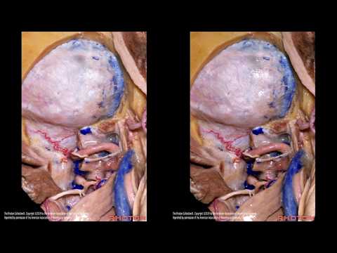 Microsurgical resection of foramen magnum meningioma thru a transcondylar approach: 3D operative vid