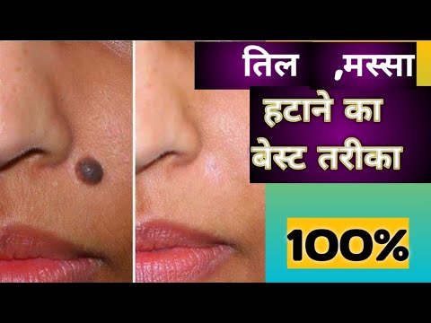 चेहरे के पुराने से पुराने तिल हमेशा के लिए ख़त्म एक रात में  Remedy to Remove Moles..