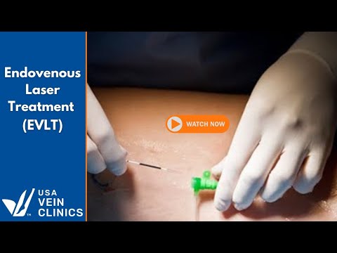 Endovenous Laser Treatment (EVLT)