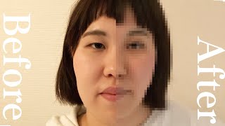 【 180日検証 】小顔矯正 マッサージ ６ヶ月 チャレンジ /  Small face correction 180 days challenge