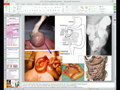 Medical School Pathology 2012 Session 054 GI-III.mp4