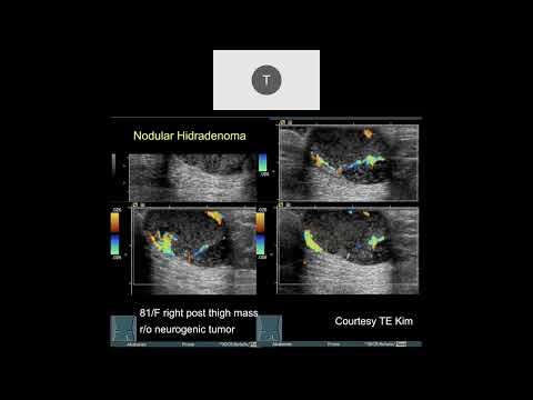 MRI of Soft Tissue Tumors | Part 4