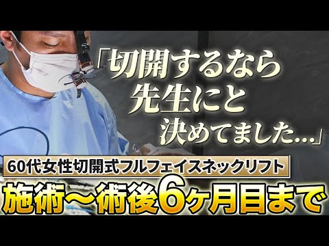 【閲覧注意】顔のたるみに効く60代女性の切開フェイスリフトの手術を解説！【脂肪吸引・バッカルファット除去】