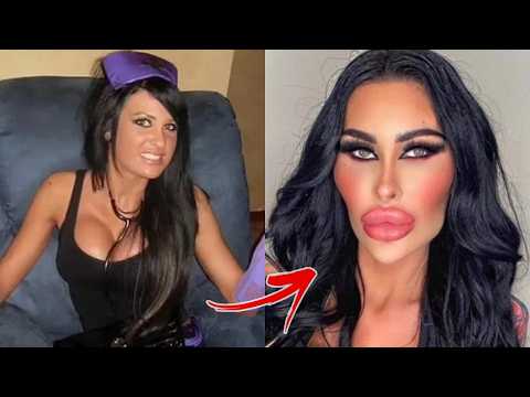 Celebrities With Permanently Botched Plastic Surgery