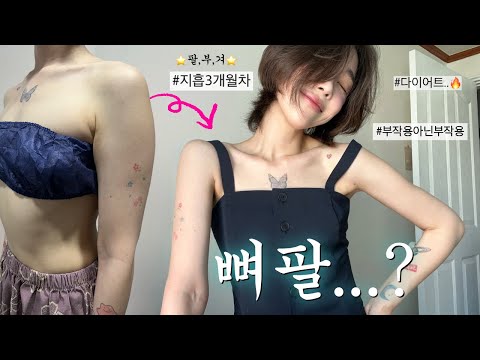 My arms get this thin? Arm, accessory breasts , armpit liposuction. Review of 3 months✨