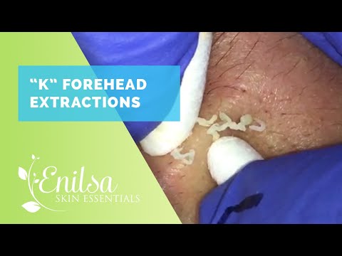 "K" Forehead Extractions Part I