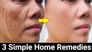 Remove Face Pigmentation Naturally.