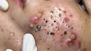 Big Cystic Acne Blackheads Extraction Blackheads & Milia, Whiteheads Removal Pimple Popping # 6914