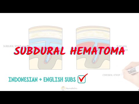 What is subdural hematoma? | Neuroaholics