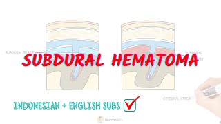 What is subdural hematoma? | Neuroaholics