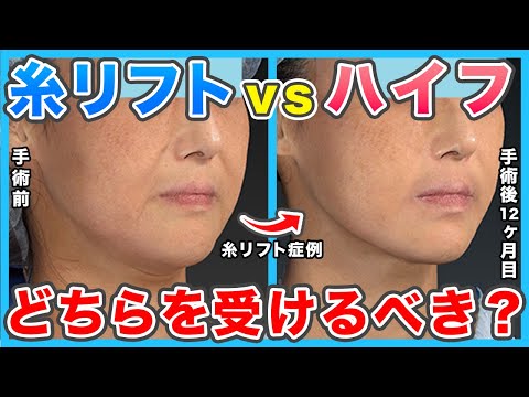 【たるみ治療】糸リフトとハイフ(HIFU)のどちらを受けるべき？