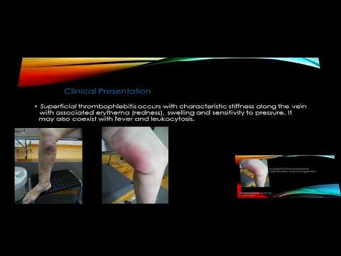 Superficial Thrombophlebitis