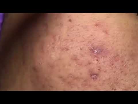 Acne Removal | Acne Milia 2019