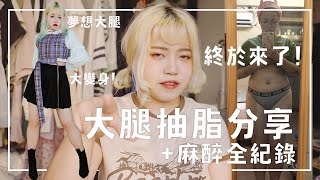 『 VLOG 』全身麻醉全紀錄!?大腿抽脂術後分享!!