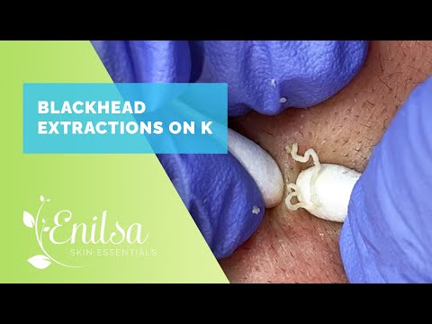 Blackhead Extractions on K - Sept 2022