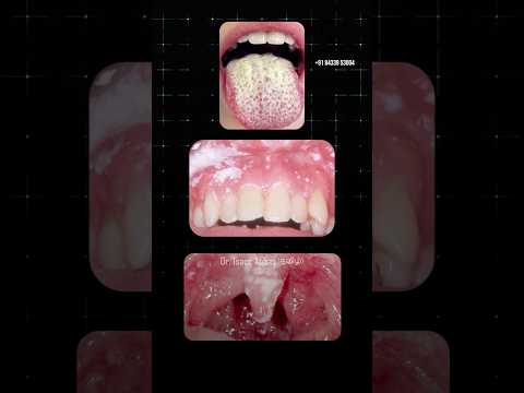 வாயில் ஏற்படும் பூஞ்சை தொற்று/ Oral Thrush- Dr. Isacc Abbas