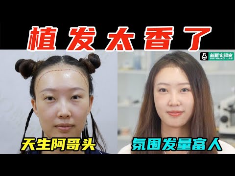 做明星同款植发是什么体验？头包脸的氛围感我终于懂了！