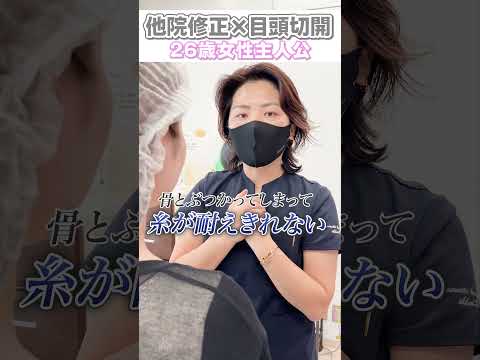 【26歳女性】他院修正×目頭切開！#shorts