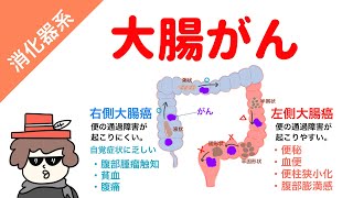 【国試対策用】大腸癌の症状