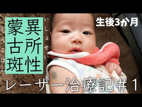 【異所性蒙古斑】レーザー治療記 #1