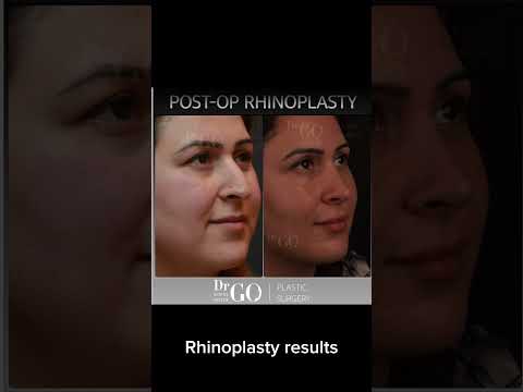 Before and after Rhinoplasty - Dr Guncel Ozturk