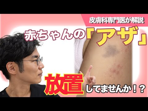 赤ちゃんのアザ放置してませんか！？