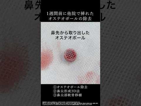 1週間前に他院で挿れたオステオポールの除去症例【形成外科専門医の鼻整形】 #形成外科専門医 #鼻整形 #他院修正 #オステオポール除去