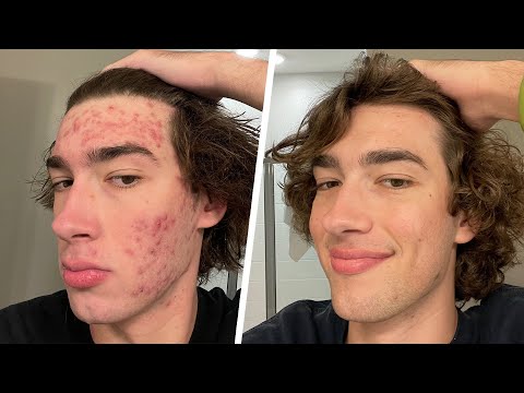 my struggles with acne