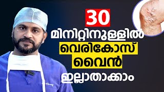 30 മിനിറ്റിനുള്ളിൽ വെരികോസ് വൈൻ ഇല്ലാതാക്കാം | VenaSeal Varicose Vein Treatment