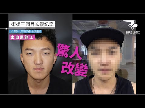 3個月恢復紀錄改善戽斗臉型-謝明吉醫師正顎手術成果