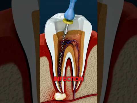 How To Survive A Tooth Infection 😧