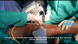 Ambulatory Phlebectomy / Microphlebectomy following EVLT Procedure  by Dr Rajesh Kumar