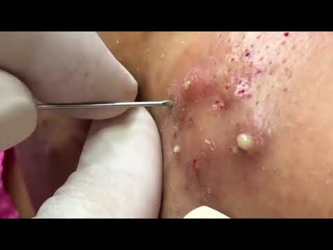 Huge Acne Removal, Skill Acne Remove 2019, Milia