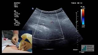 Thrombin injection for post renal biopsy haemorrhage