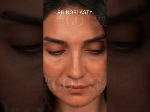 Rhinoplasty Transformation by Assoc. Prof. Dr. Güncel Öztürk | Before & After Results