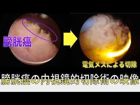 膀胱癌の実際の内視鏡切除術の動画です。解説つきの動画です。