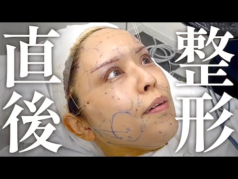 ジェントル式全顔若返りの施術の様子&術直後インタビュー！