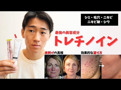 【最強成分】トレチノインの効果と使い方！毛穴・ニキビ・ニキビ跡の経過から皮剥けまで