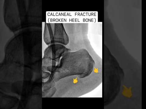 Why CT Scan important in fracture bone