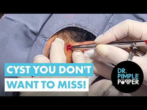 A Cyst You DON'T WANT to Miss!